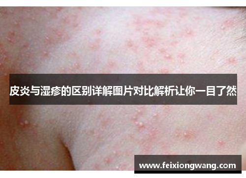 皮炎与湿疹的区别详解图片对比解析让你一目了然